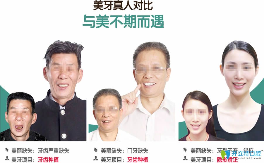 無錫北極星口腔種植牙真人效果對(duì)比圖
