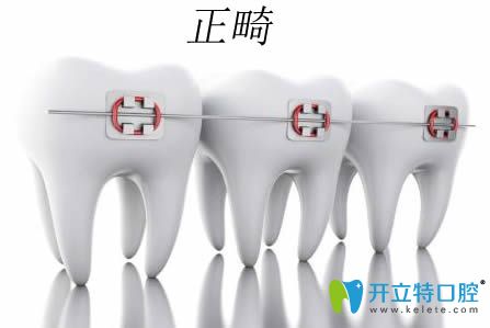 牙齒矯正中常見的10個(gè)問題