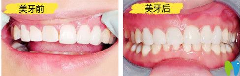 東莞好佰年口腔全瓷牙修復案例