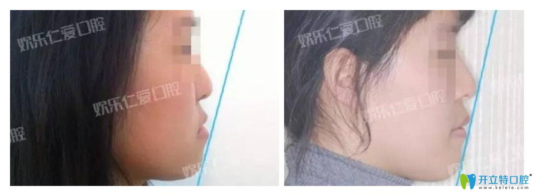 沈陽歡樂口腔怎么樣？肖春正畸案例公布