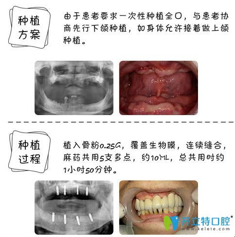 東莞好百年口腔怎么樣？60歲老人全口牙種植案例見證