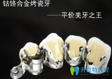鈷鉻烤瓷牙