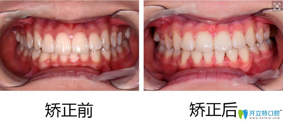 深覆頜牙齒矯正前后對比效果圖