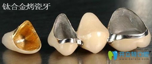 鈦合金烤瓷牙