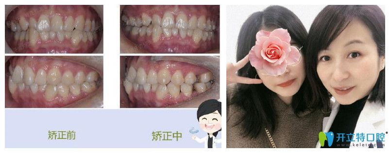 福州維樂(lè)口腔郭淑蘋(píng)牙齒矯正案例