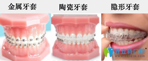 金屬牙套及陶瓷牙套的圖片