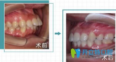 福州維樂(lè)口腔許長(zhǎng)記醫(yī)生成人齙牙矯正前后對(duì)比照