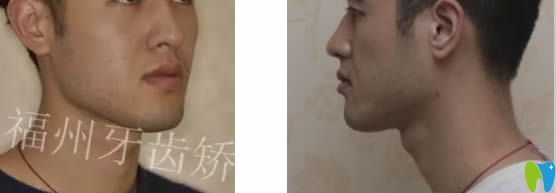福州維樂(lè)口腔郭淑蘋(píng)醫(yī)生成人上下前牙反頜矯正臉型對(duì)比效果