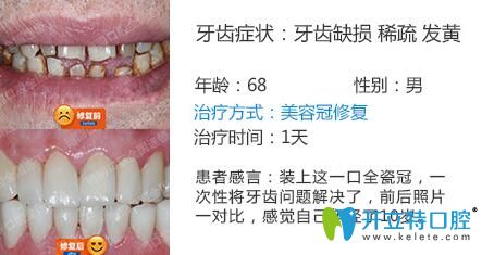 南京博韻口腔周光正靠譜嗎？美容冠修復(fù)案例公布