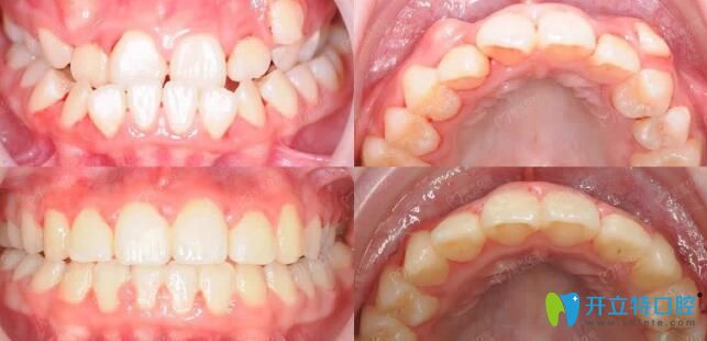 極光口腔美式兒童頜面管理，面型干預(yù)效果前后對比