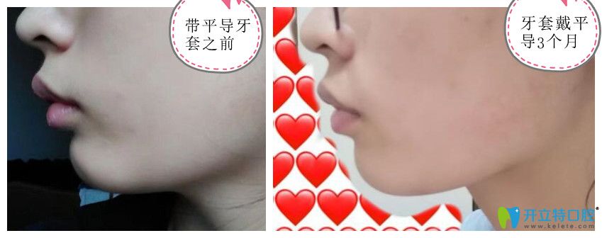 牙齒矯正戴平導3個月前后對比照