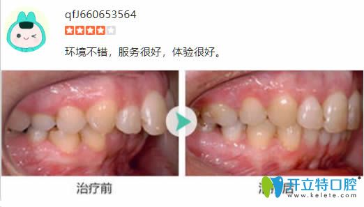 28歲顧客在麗江錦美口腔做完齙牙矯正前后對比效果