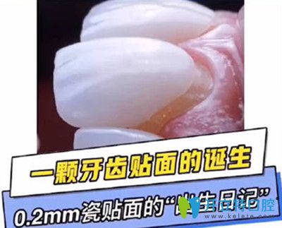 如果瓷貼面做了后悔死了，趕緊來了解德國(guó)冰瓷牙貼面