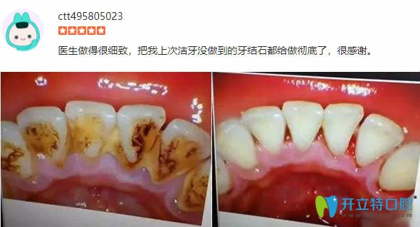 顧客在麗江錦美體驗洗牙后前后對比照