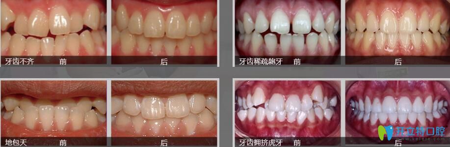 東莞好佰年正畸怎么樣？張子捷幾例子牙齒矯正案例效果對比圖來說明