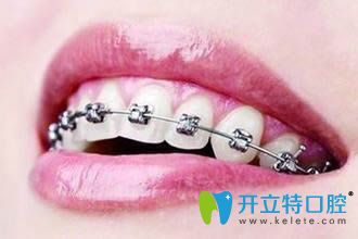 矯正牙齒老了會(huì)容易掉嗎