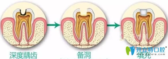 牙神經(jīng)壞死治療過程圖