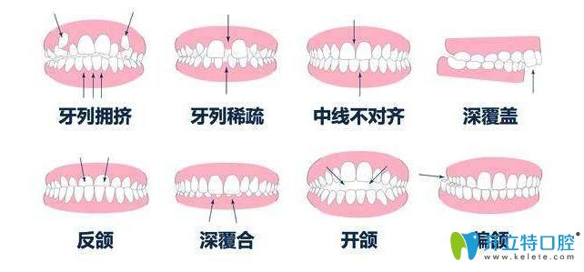 個(gè)人的牙齒情況也影響矯正的價(jià)格