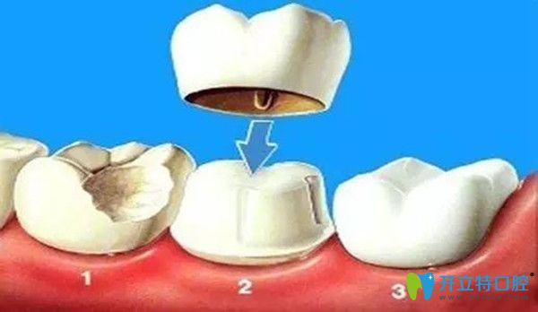 做完牙冠修復后悔了，牙冠修復的意義何在？