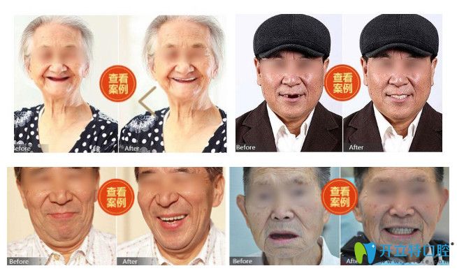 長(zhǎng)沙中諾口腔全口和半口種植牙案例圖