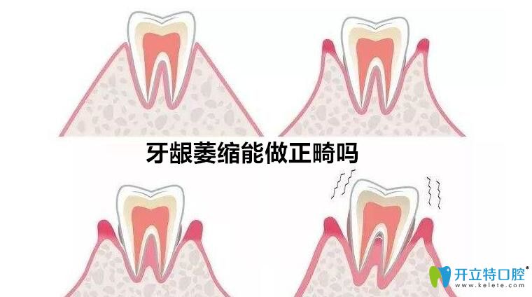 牙齦萎縮能矯正牙么？聽泗洪口腔正畸醫(yī)生解說