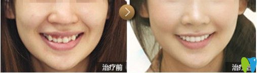 天津中諾口腔成人牙齒擁擠不齊隱適美矯正對(duì)比