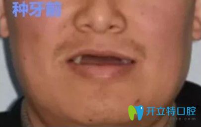 張先生來韓國安特麗牙科做種植牙術(shù)前照