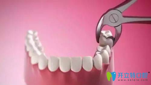 不拔牙矯正效果好不好?連江縣明輝口腔院長(zhǎng)是這樣說(shuō)的.....