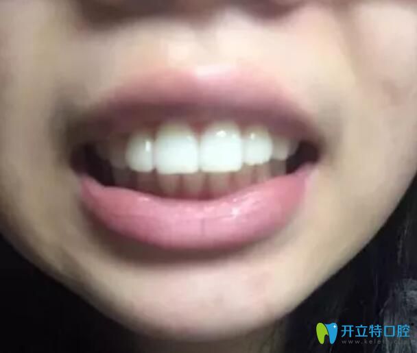 骨性+牙性齙牙在太原華美矯做了金屬鋼絲矯正，現(xiàn)下牙套了
