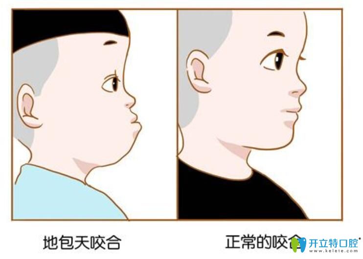 小孩地包天換牙會(huì)好嗎？太原華美口腔正畸專家解說