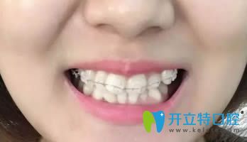 在連江縣明輝口腔做的陶瓷矯正歷經(jīng)18個(gè)月終于要下牙套了！