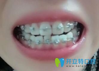 我在<!--<i data=20240703-sp></i>-->圣貝口腔做牙齒矯正第10個月
