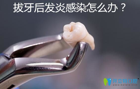 拔牙后發(fā)炎感染了怎么辦？感染癥狀有哪些你知道嗎？