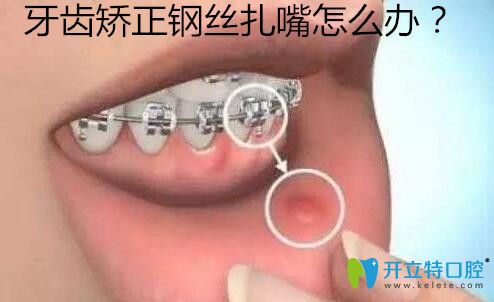 牙齒矯正鋼絲磨嘴扎嘴怎么辦