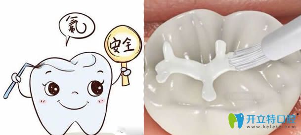 兒童防齲齒-做了窩溝封閉后還需要做涂氟嗎？能同時(shí)做嗎?