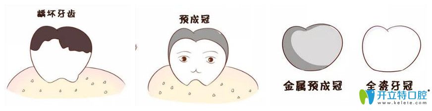 兒童乳牙預(yù)成冠是什么？比樹脂填充好在哪里？