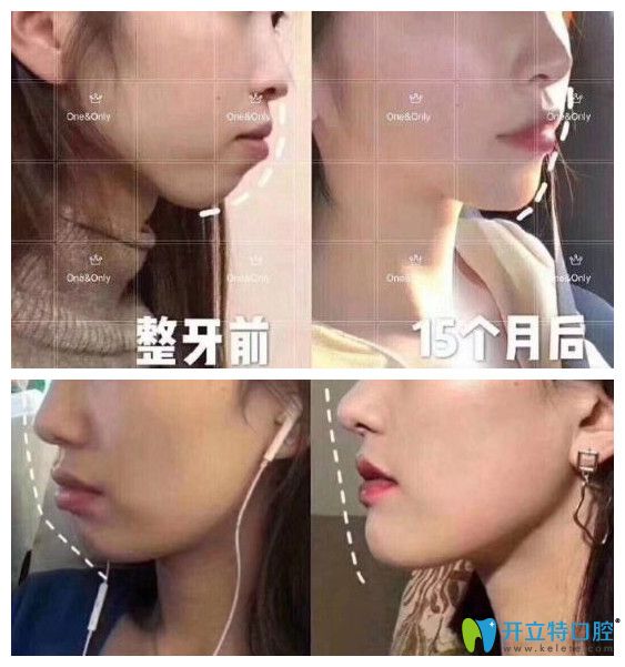 廣州壹加壹矯正牙齒好嗎？小姐姐在壹加正畸打卡記錄公開