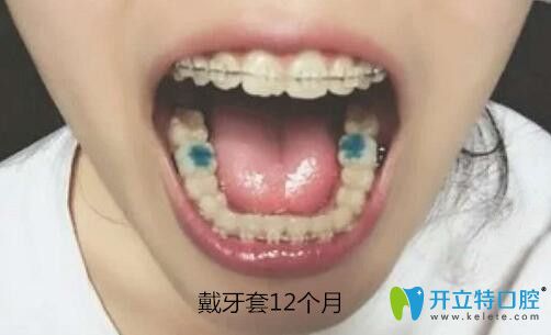 我在梅州中大口腔做陶瓷托槽牙齒矯正12個(gè)月