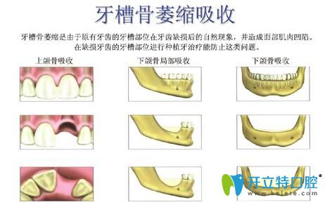 牙槽骨萎縮就不能做種植牙了嗎？NO,補(bǔ)救方法來(lái)啦！