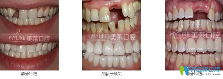 深圳種植牙哪家好？來(lái)看美萊口腔真人種植牙案例效果對(duì)比圖