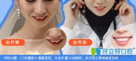仁愛口腔牙齒外漏、擁擠矯正案例