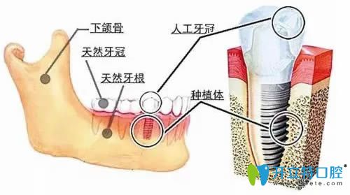 種植牙后做正畸需要避開這顆種植牙