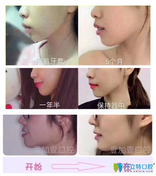 廣州壹加壹口腔牙齒矯正實(shí)例療效對比圖