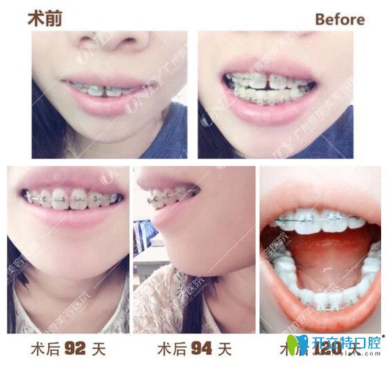 壹加壹齙牙，門(mén)牙縫隙矯正過(guò)程中牙齒變化圖