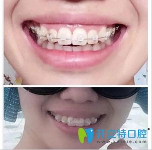 在東莞壹加壹口腔做陶瓷半隱形牙齒矯正術中照