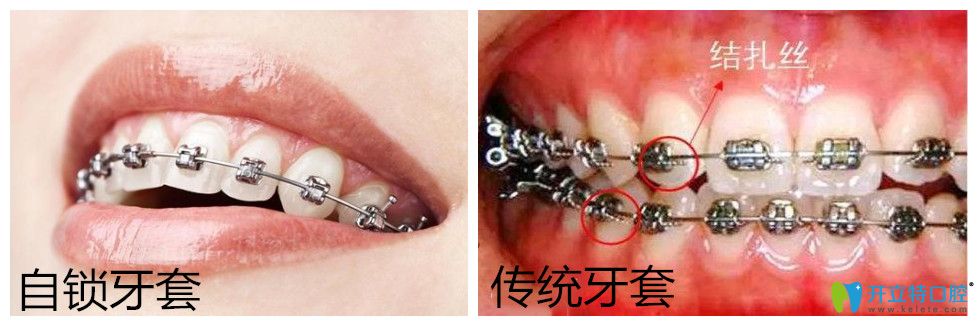 自鎖托槽牙齒矯正多少錢？正畸國產(chǎn)與進(jìn)口自鎖有區(qū)別嗎?