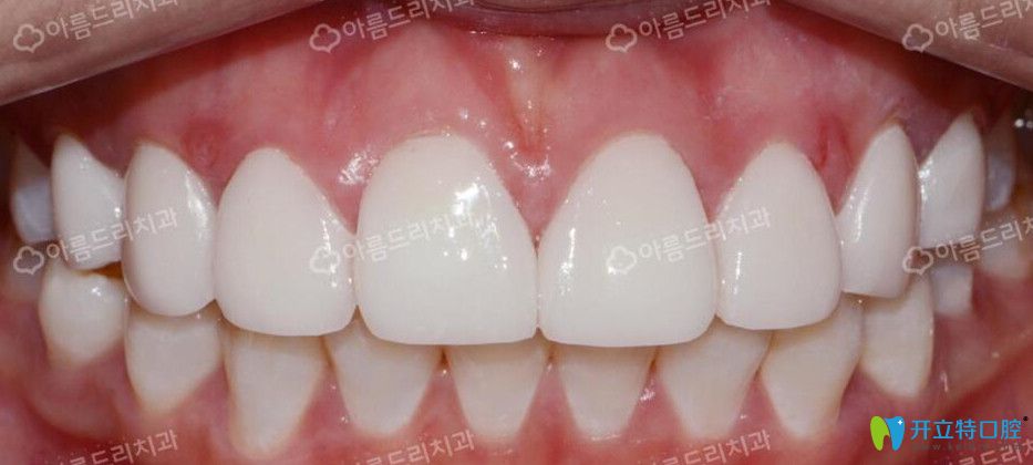 韓國安特麗做牙齒矯正后照片