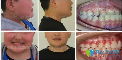 鄭州拜博口腔青少年牙齒正畸前后對比圖