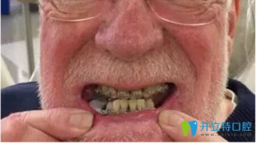 問40歲做牙齒矯正好不好?這還有鄭州拜博口腔60歲正畸案例呢