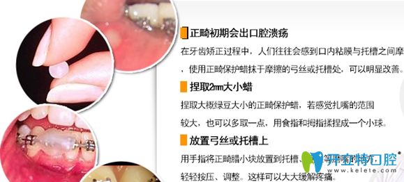 牙套托槽磨嘴怎么辦，可使用正畸蠟來保護口腔粘膜